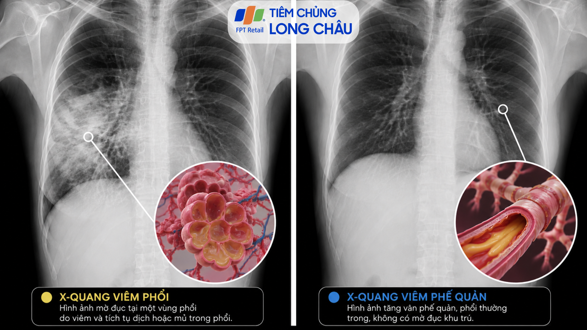 thời gian hồi phục viêm phế quản - Image 4