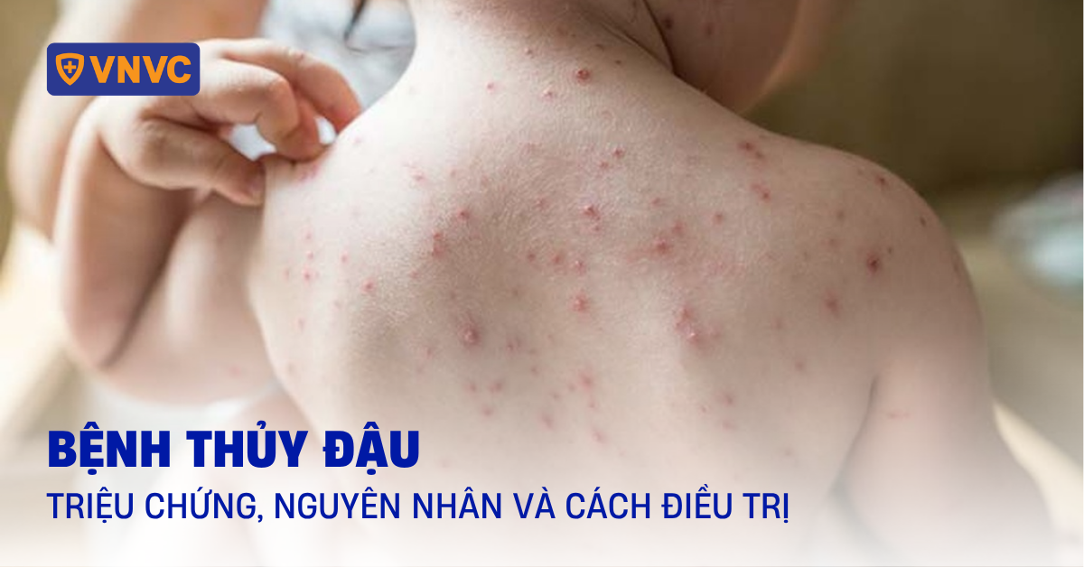 thủy đậu - Image 4