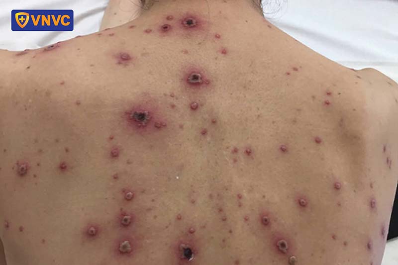 thủy đậu bội nhiễm