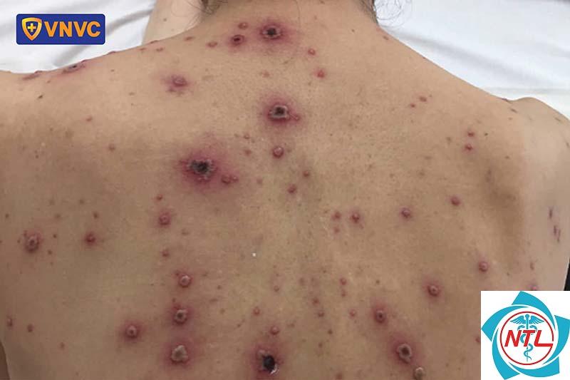 thủy đậu gây nhiễm trùng da - Image 4