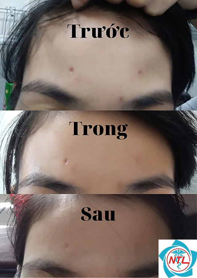 thủy đậu gây sẹo - Image 2