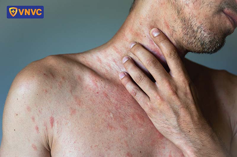 thủy đậu ở người cao tuổi