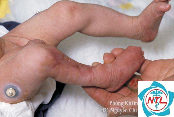 thủy đậu ở người đang mang thai - Image 3