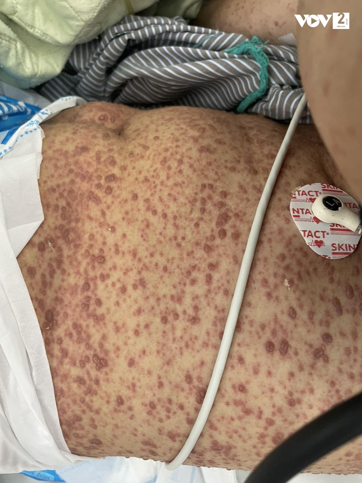 thủy đậu ở người lớn - Image 3