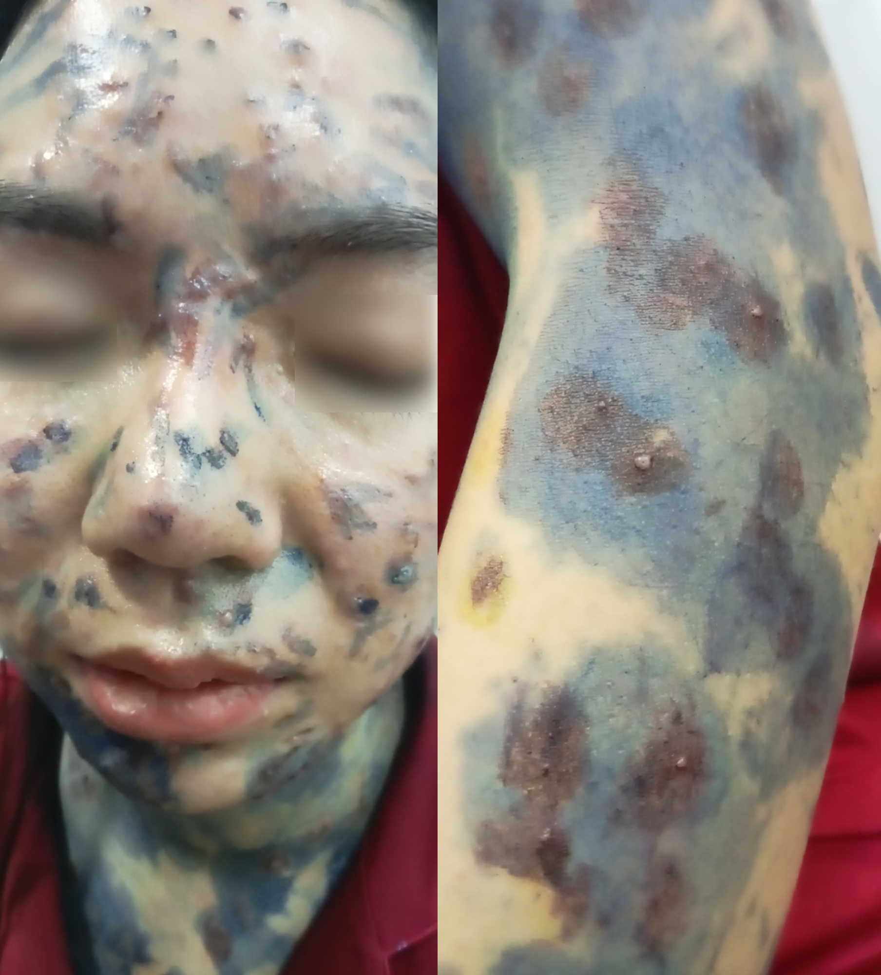 thủy đậu ở người lớn - Image 4
