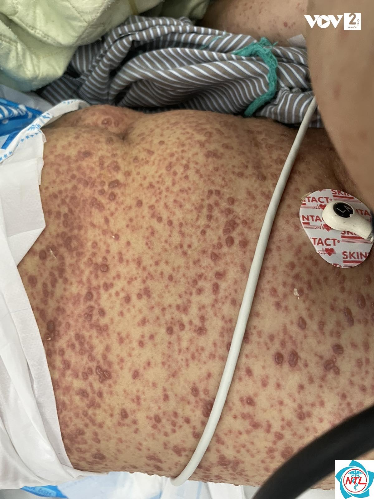 thủy đậu ở người suy giảm miễn dịch - Image 4