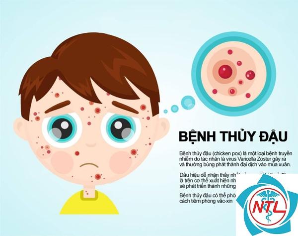 thủy đậu ở người suy giảm miễn dịch