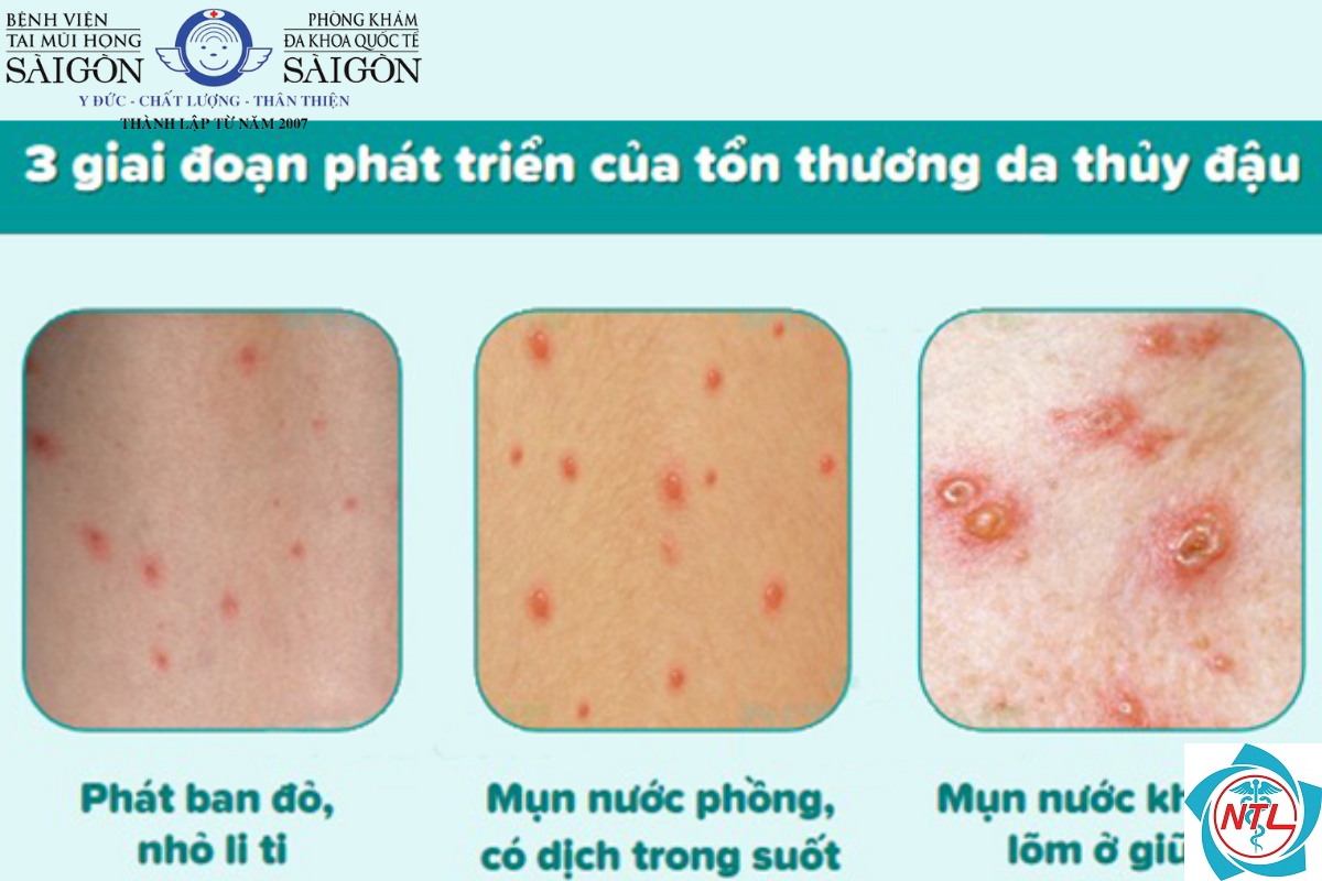 thủy đậu ở thanh thiếu niên - Image 5