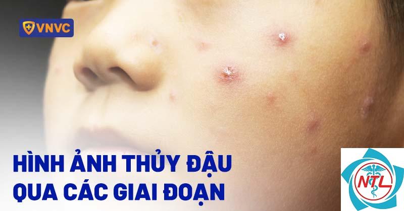 thủy đậu ở thanh thiếu niên