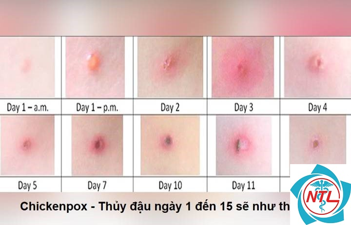 thủy đậu ở trẻ nhỏ - Image 4