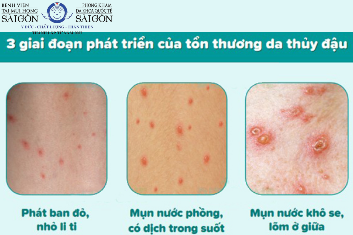 thủy đậu tái phát - Image 4
