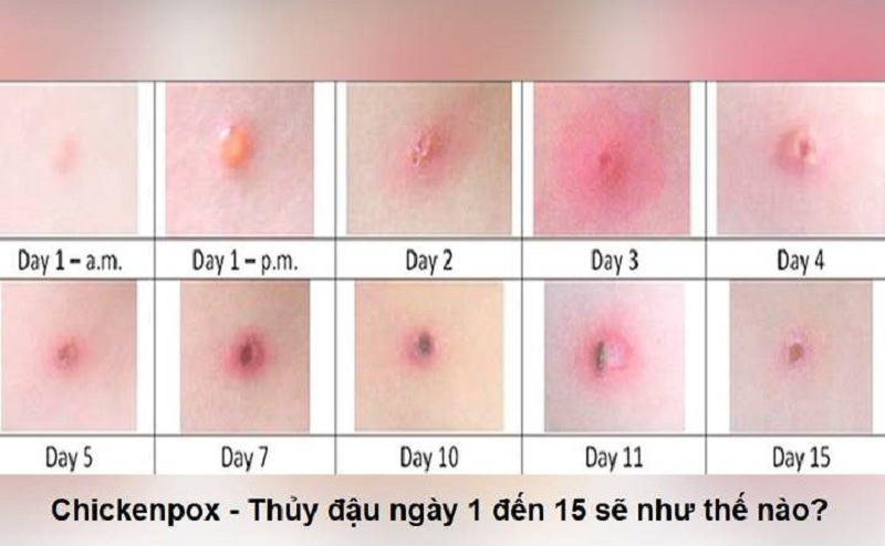 thủy đậu