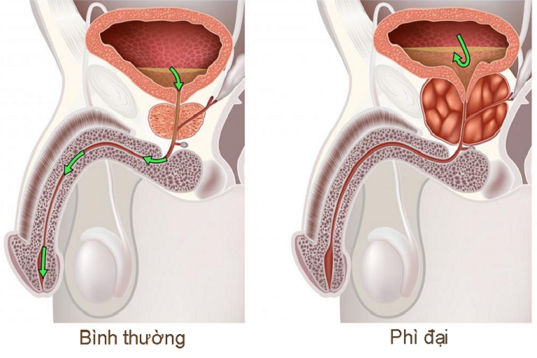 tiểu buốt ở người cao tuổi - Image 2