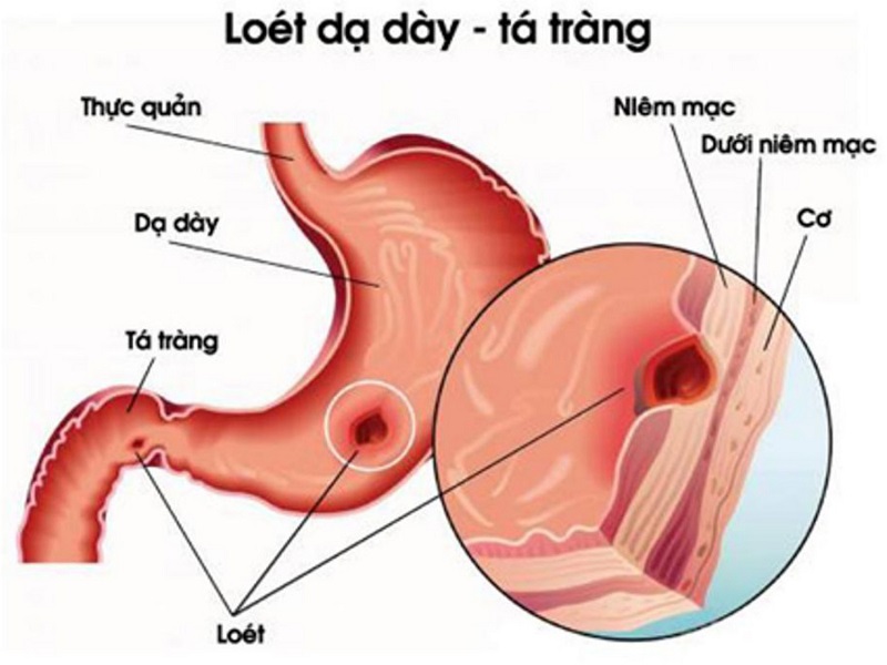 tiêu chảy kèm đau bụng - Image 4
