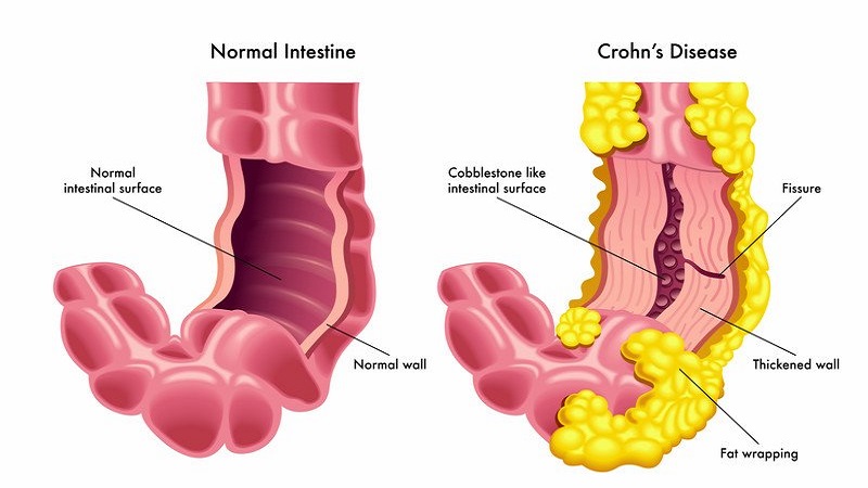 tiêu chảy kéo dài ở người cao tuổi - Image 4