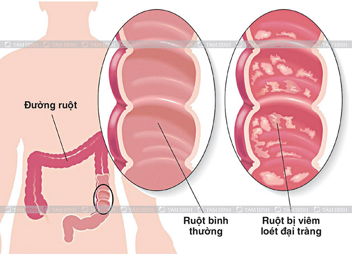tiêu chảy ở người có bệnh mạn tính