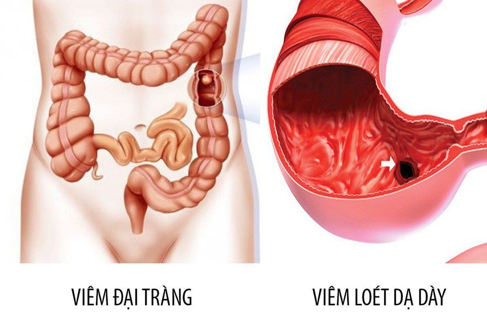 tiêu chảy về đêm ở người lớn - Image 4