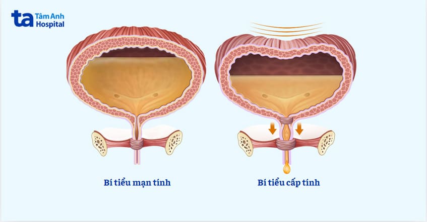 tiểu ít đột ngột - Image 2