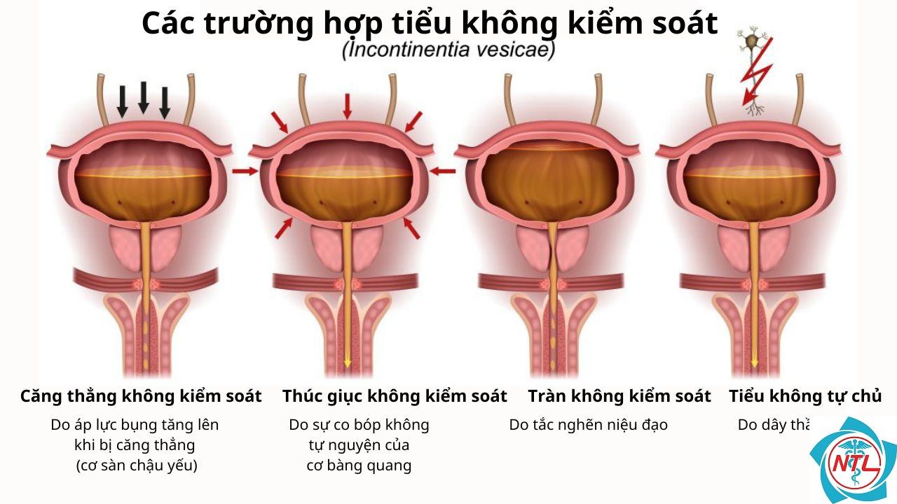 tiểu không tự chủ do thôi thúc - Image 2