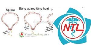 tiểu không tự chủ hỗn hợp - Image 5
