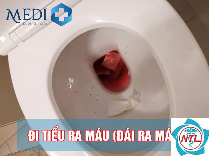 tiểu máu - Image 5