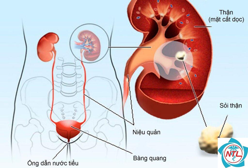 tiểu máu do sỏi tiết niệu