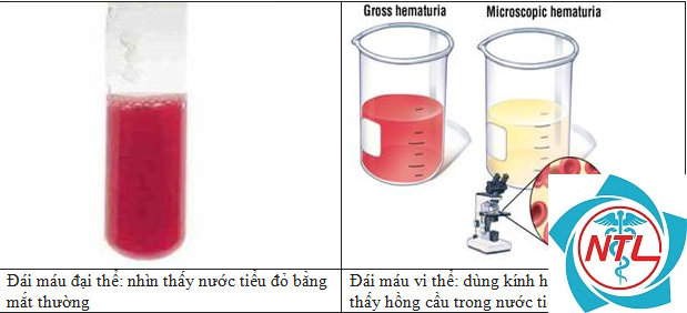 tiểu máu do sỏi tiết niệu - Image 2