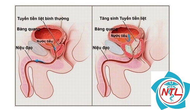 tiểu nhiều lần - Image 4