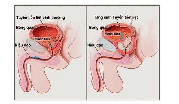 tiểu nhiều lần là dấu hiệu gì - Image 2