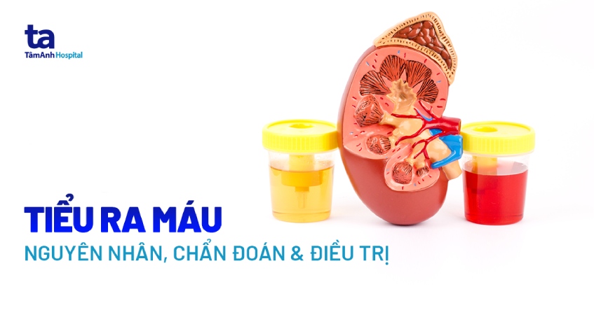 tiểu ra máu kèm đau lưng - Image 5