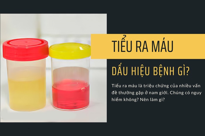 tiểu ra máu là dấu hiệu bệnh gì - Image 4