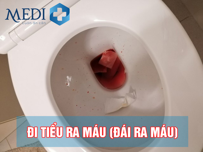 tiểu ra máu là dấu hiệu bệnh gì - Image 1