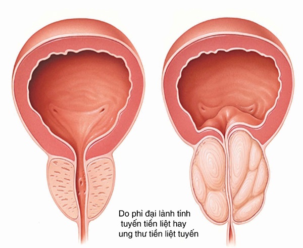 tiểu ra máu ở người lớn - Image 3