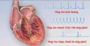 tim đập chậm