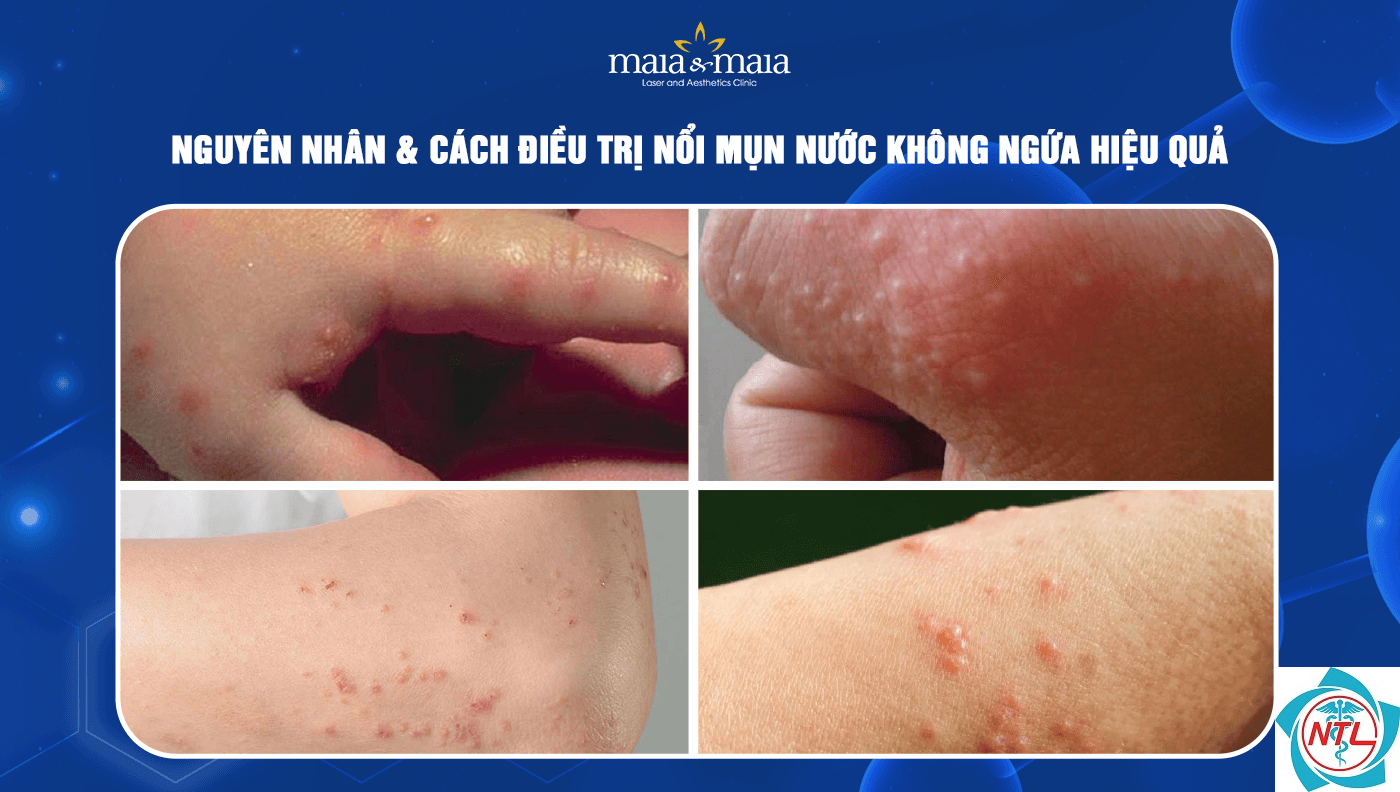 tổn thương da dạng mụn nước - Image 2