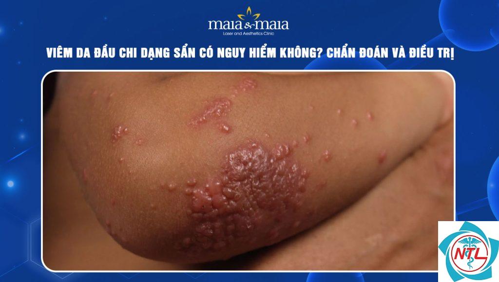 tổn thương da dạng sẩn - Image 5