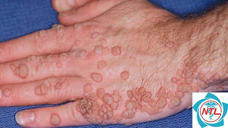 tổn thương da do HPV - Image 2
