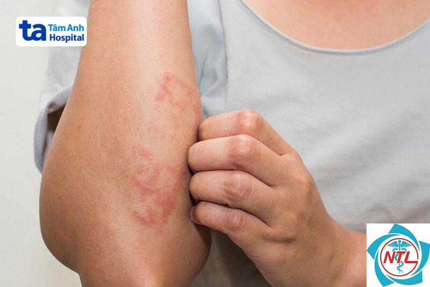 tổn thương da do HPV - Image 3