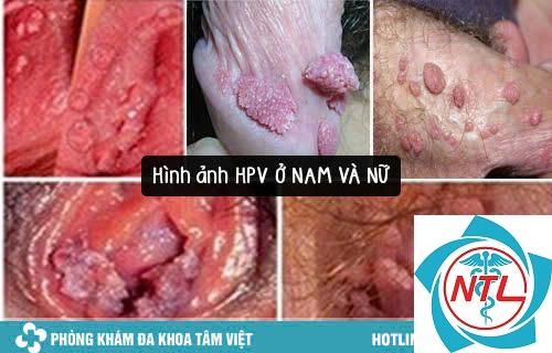 tổn thương da do HPV - Image 5