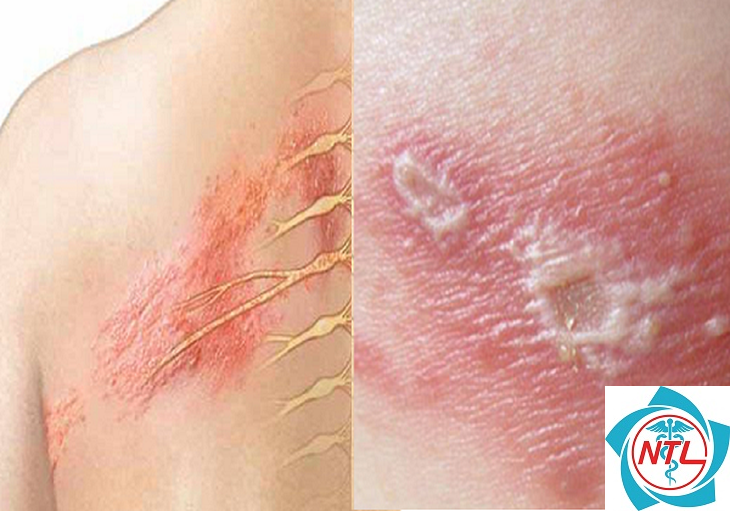 tổn thương da do HPV