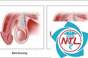 tràn dịch màng tinh hoàn