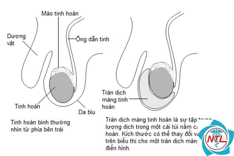 tràn dịch màng tinh hoàn - Image 4