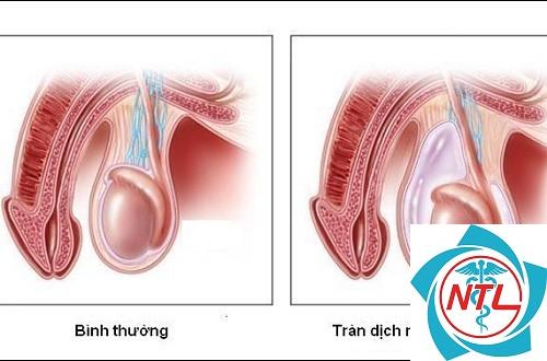 tràn dịch màng tinh hoàn