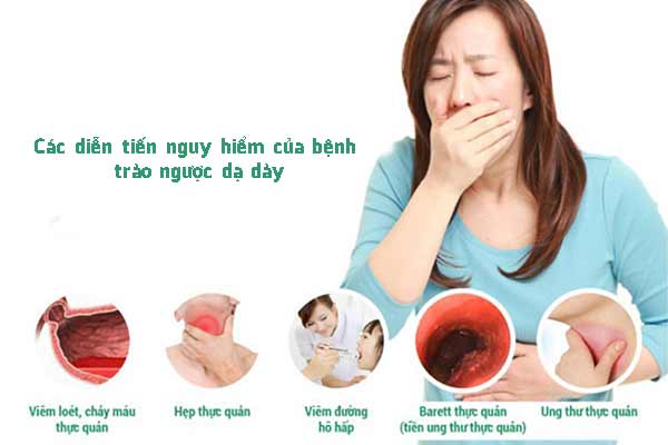 trào ngược dạ dày có nguy hiểm không - Image 3