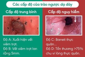 trào ngược dạ dày có nguy hiểm không