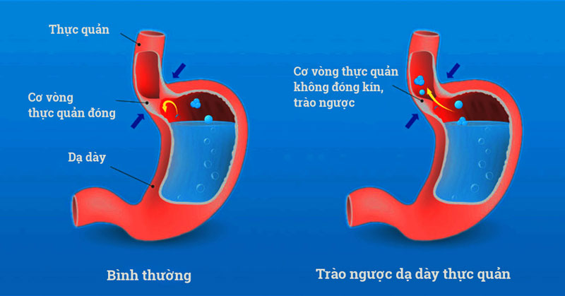 trào ngược dạ dày có nguy hiểm không - Image 4