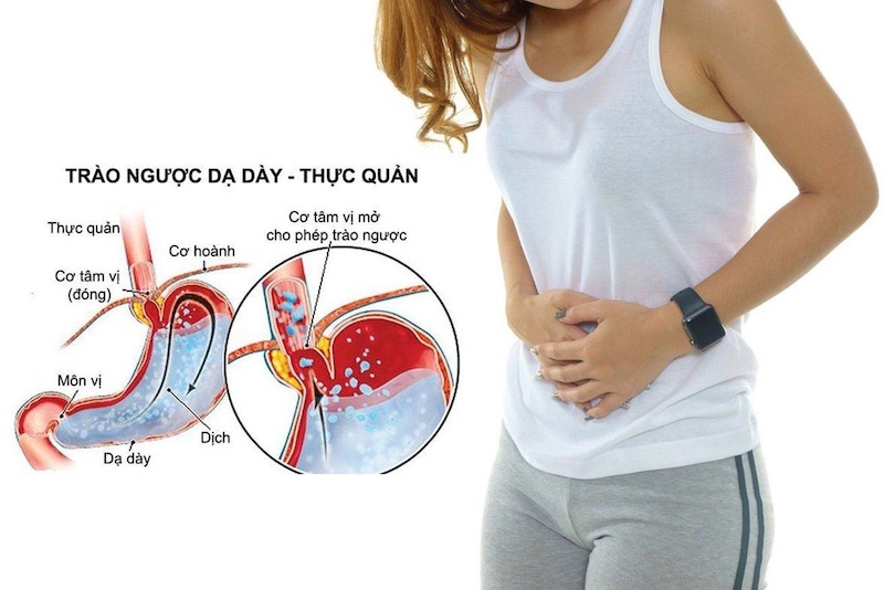 trào ngược dạ dày có nguy hiểm không - Image 5