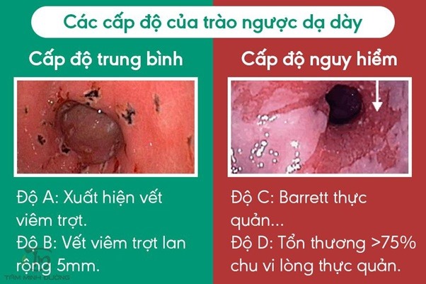 trào ngược dạ dày có nguy hiểm không - Image 1