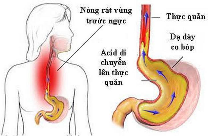 trào ngược dạ dày gây ho - Image 2