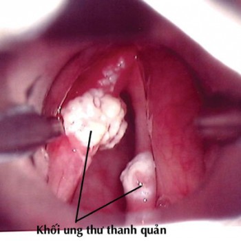 trào ngược dạ dày gây khàn tiếng - Image 2